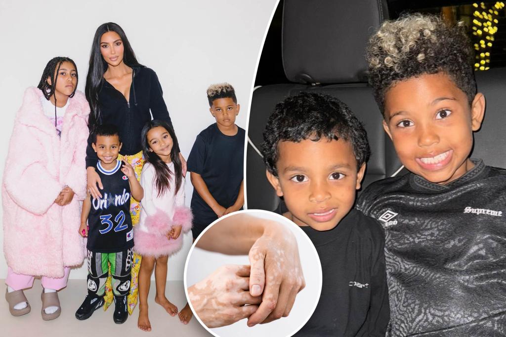  Kim Kardashian's Son Diagnosed With Vitiligo 