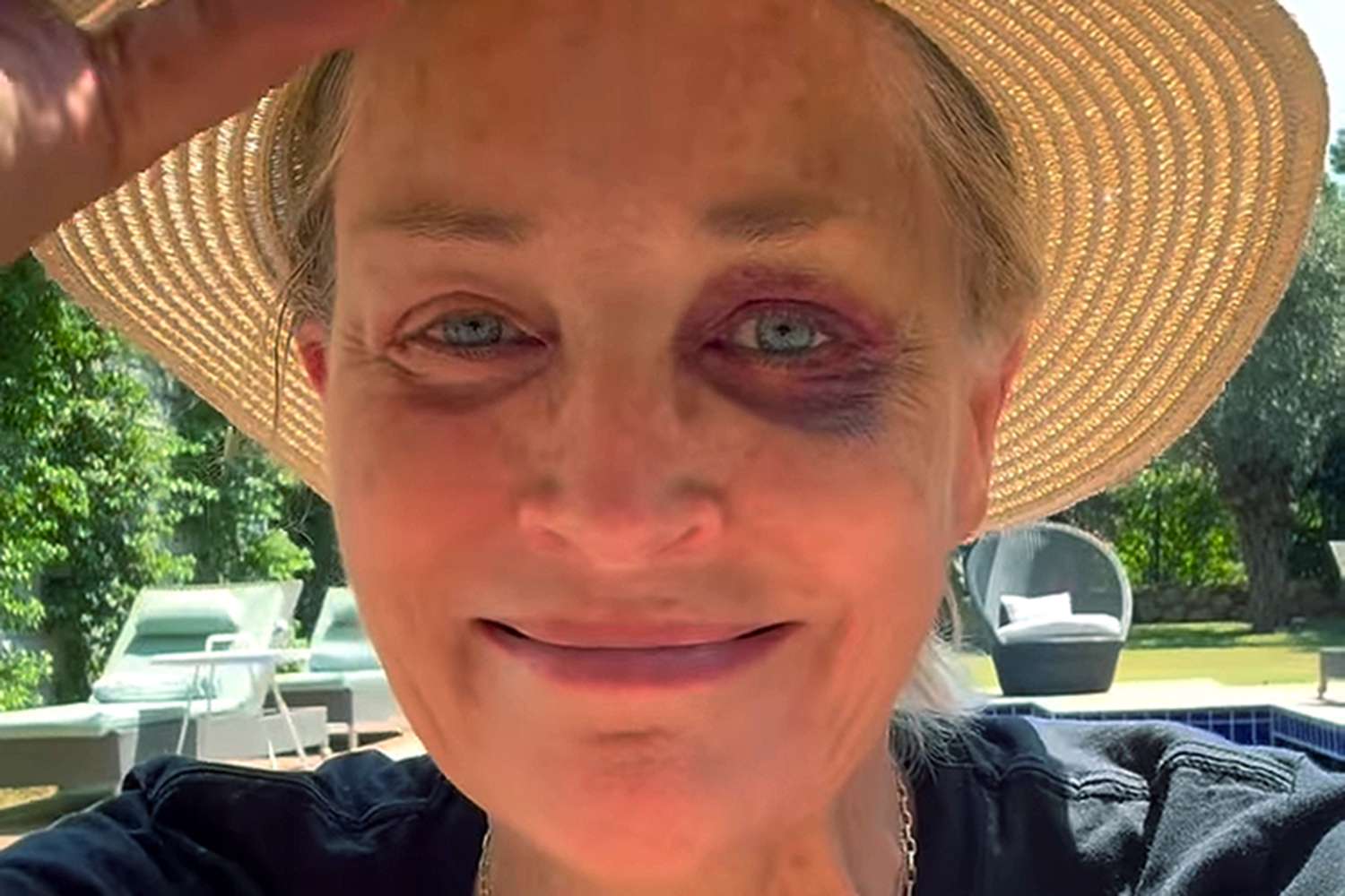 Sharon Stone Explains How She Got a Black Eye on Holiday