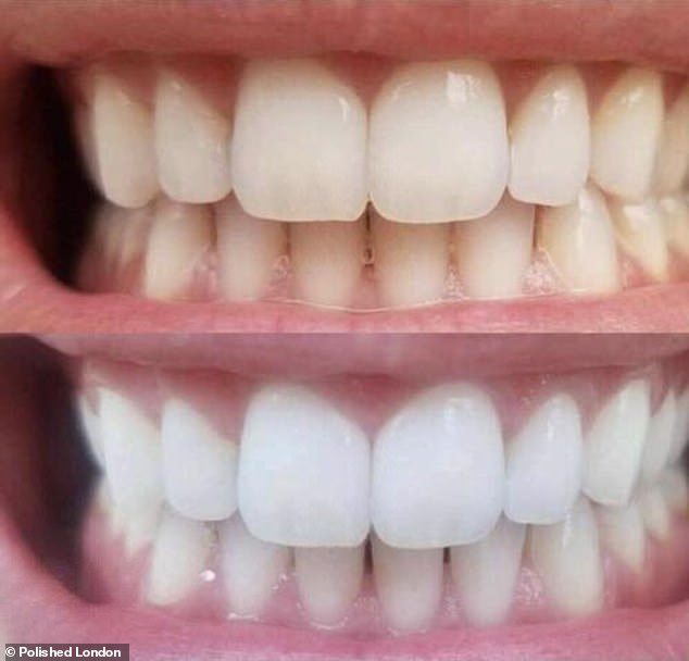 Brighter Smile: Dentist-Approved Teeth Whitening Powder Takes Off